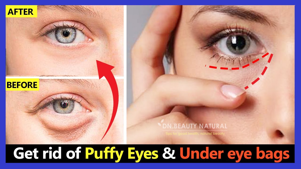 How to Get rid of Puffy Eyes and Under eye bags in 2 weeks. Facial Exercises & Lymphatic Eye Massage