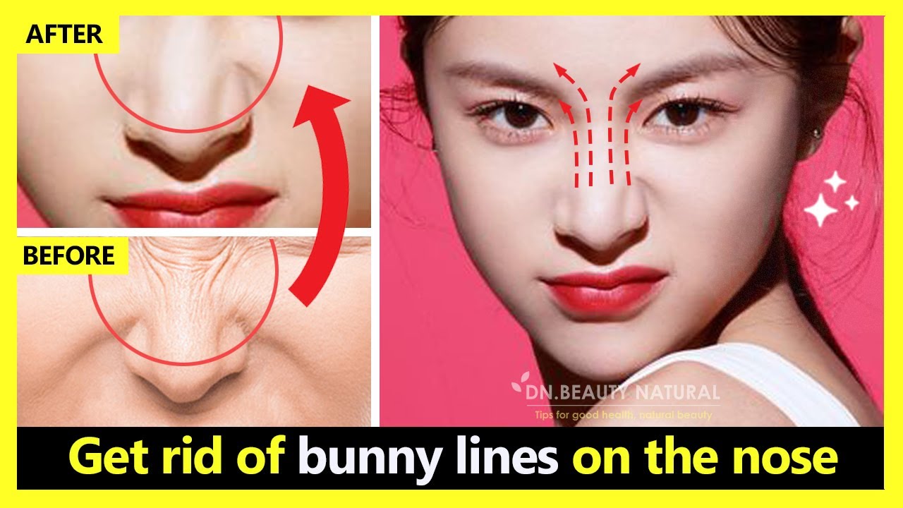 Just 4 minutes! How to get rid of bunny lines on the nose, nose wrinkles naturally.