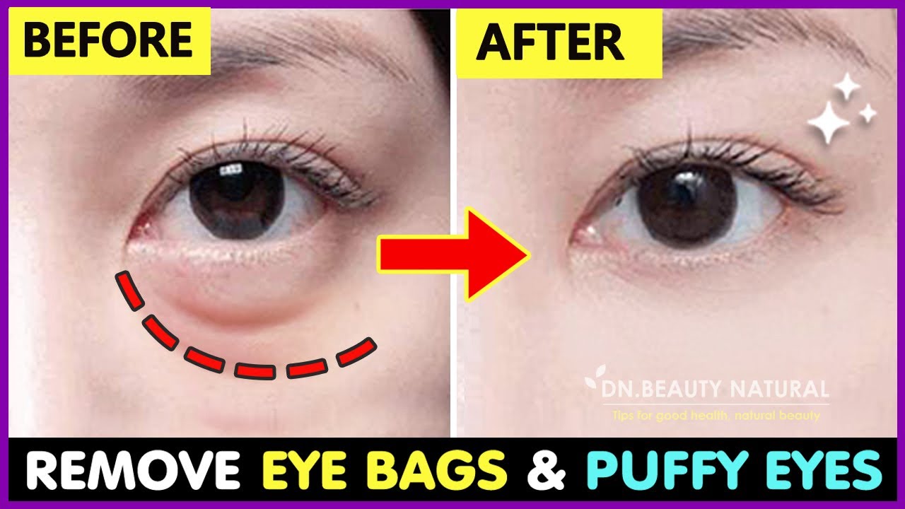 (Fast results) Remove Bags Under Eyes, Puffy Eyes permanent, Fillers under eyes | Exercise & Massage